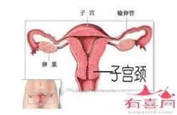 杭州代生能选男女吗，卵巢囊肿可以吃土豆吗吗？土豆能治疗卵巢囊肿吗？